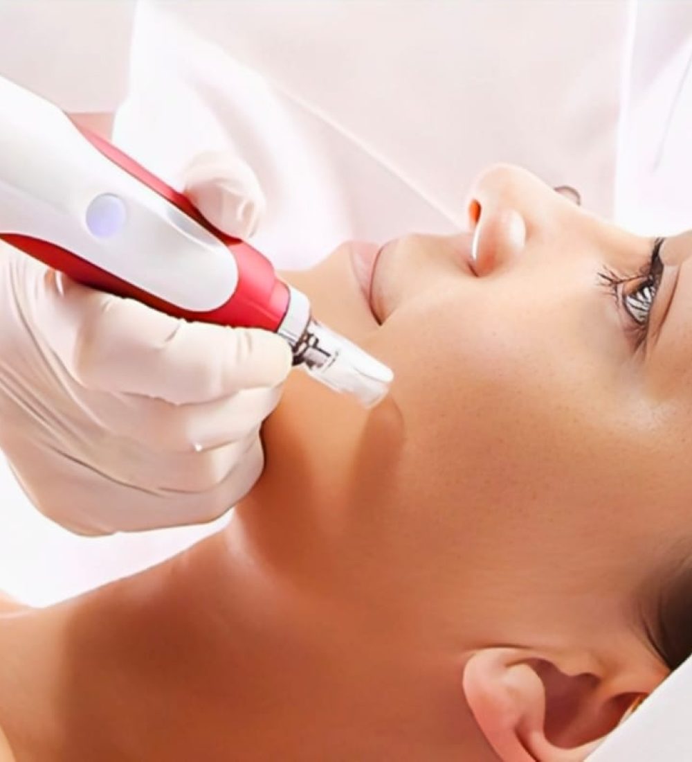 Micro-Needling (Full Face)