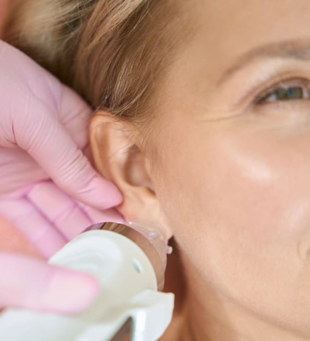 RF Needling (Radio Frequency Microneedling)